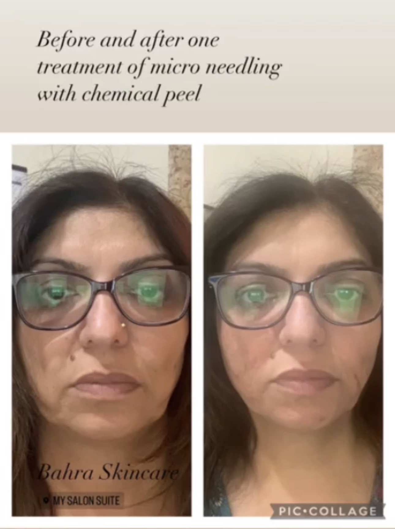 Before and after one treatment of Derma Pen treatment with chemical exfoliation